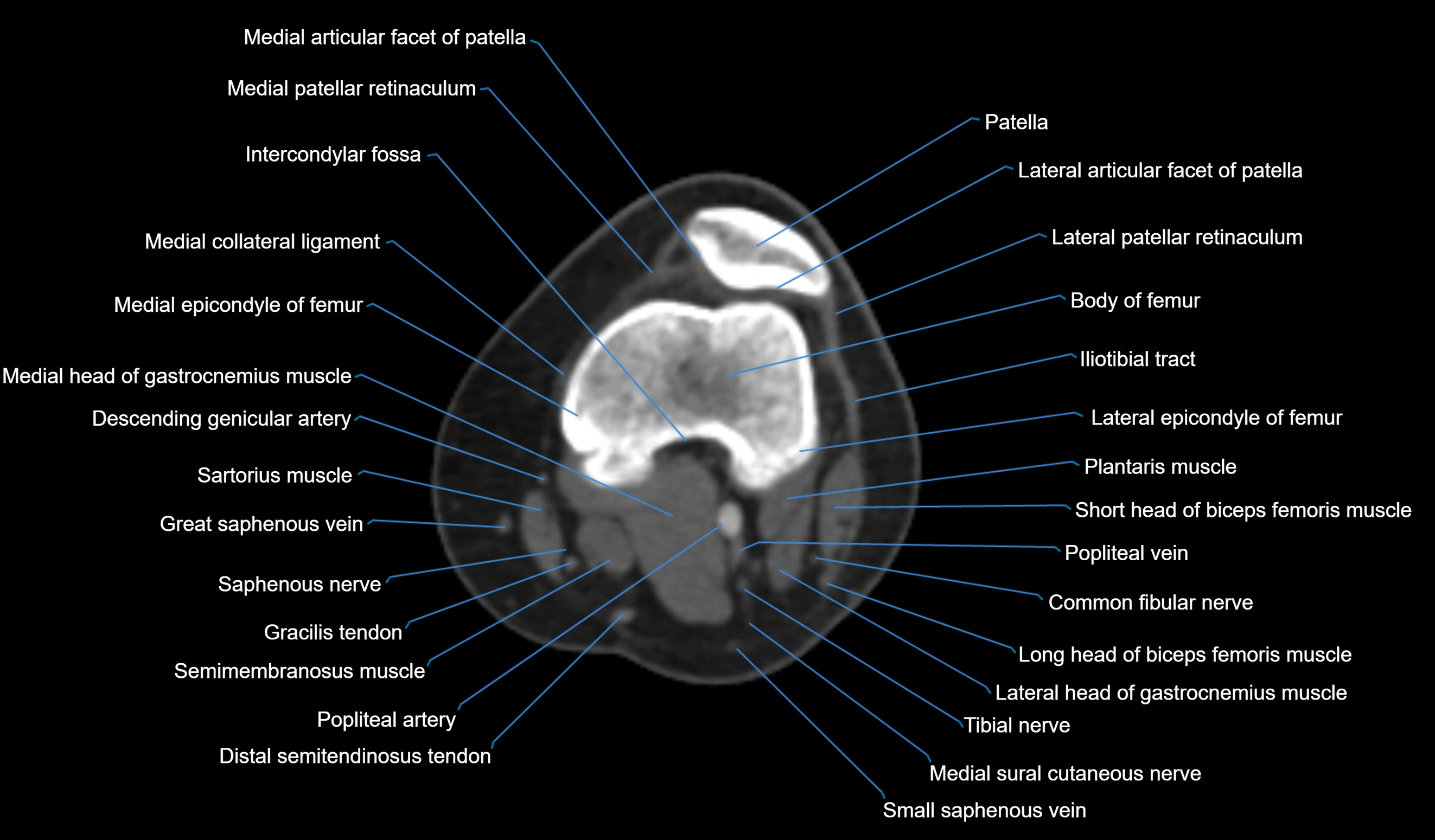 CT knee axial cross sectional anatomy labelled image-00024.webp